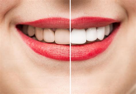 Unlock the Secrets of Magical Tooth Whitening